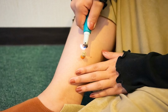 セルフケア：お灸